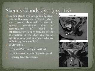 inflammation glande de skene|Skene’s Gland Cyst: Causes, Symptoms & Treatment